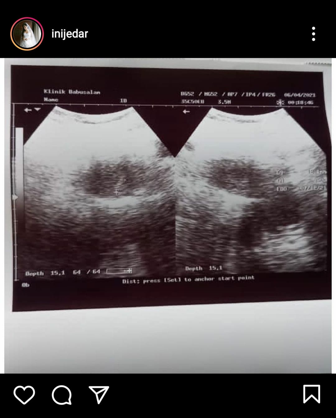Jessica Iskandar pamer foto USG. Instagram @inijedar