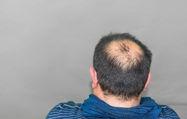 Ilustrasi alopecia aerata. Foto: Alodokter