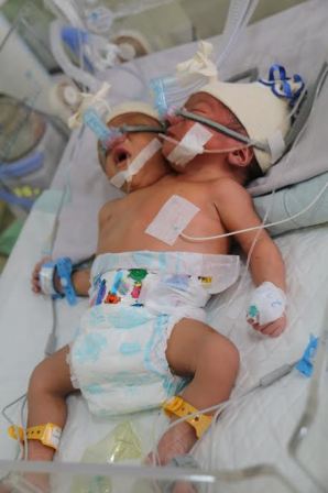 RSUP H. Adam Malik Rawat Dua Pasang Bayi Kembar Siam