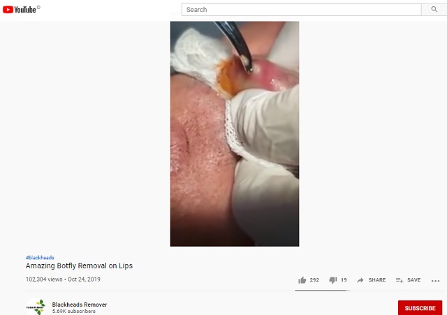 [Cek Fakta] Cacing Parasit yang Dikeluarkan dari Dalam Bibir Pria Ini Berasal dari Kaleng Minuman? Ini Faktanya