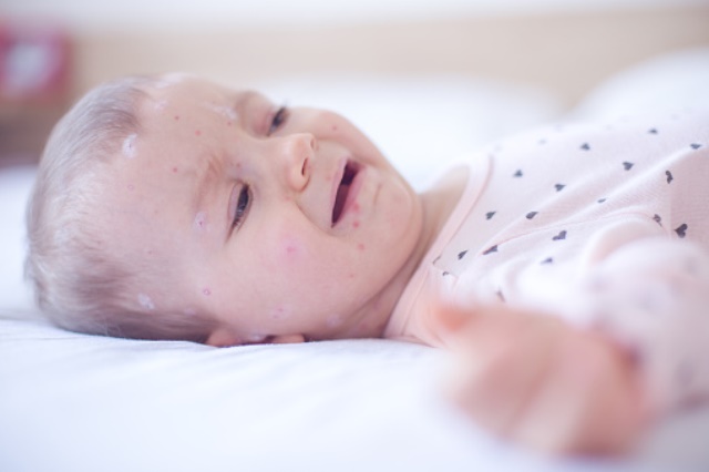 Cara Penularan Cacar Air