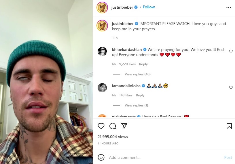 Justin Bieber mengalami Ramsay Hunt Syndrome. Instagram justinbieber