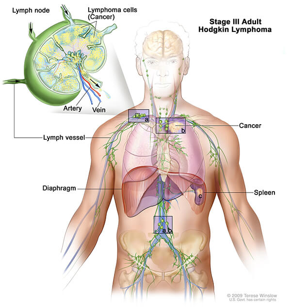 Pembrolizumab, Imunoterapi untuk Kanker Paru Stadium Lanjut