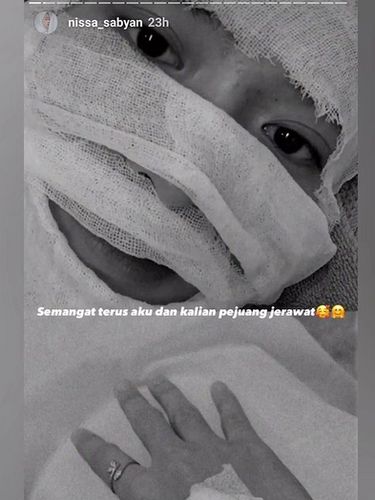 Wajah Nissa Sabyan Penuh Perban, Netizen: Itu Azab!