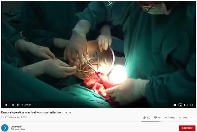 Video Operasi Bedah Usus Mengeluarkan Mie Instan? Ini Faktanya