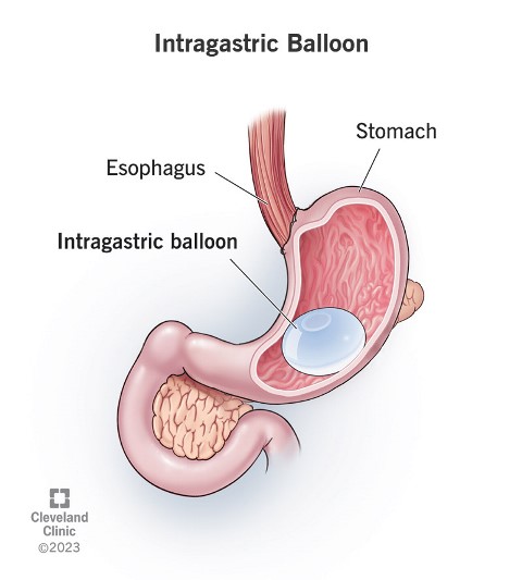 Gastric balloon apakah aman