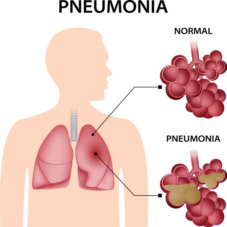pnumonia 2