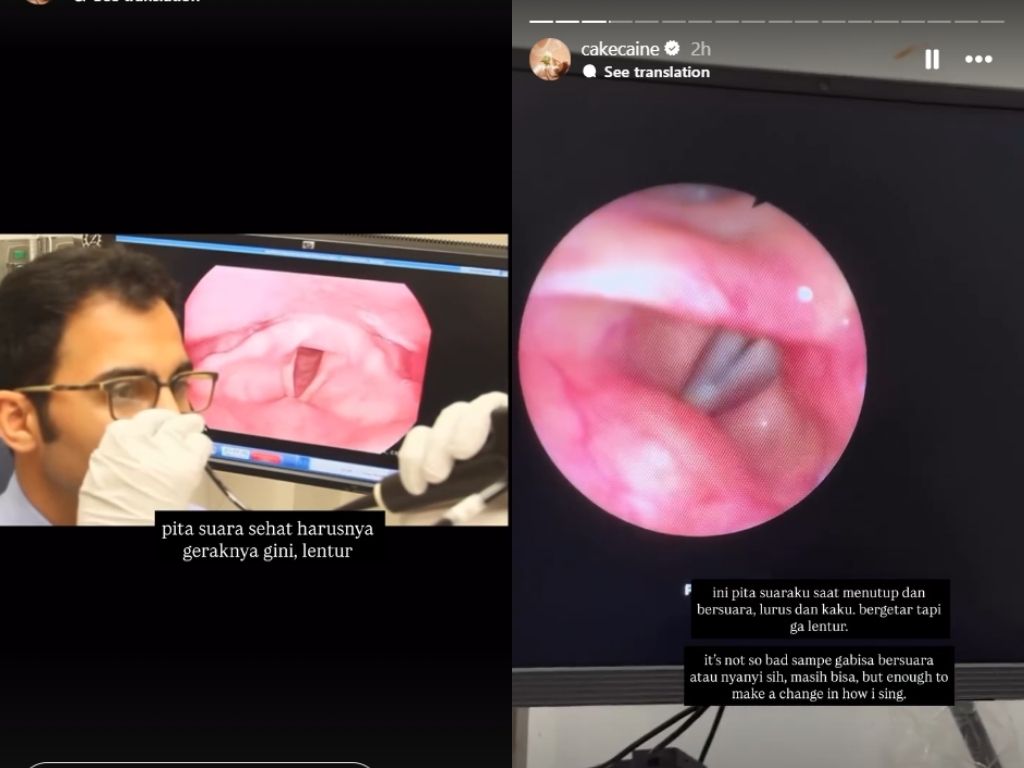 Nadin Amizah Alami Gangguan Pita Suara, Ini Gejala yang Dirasakannya